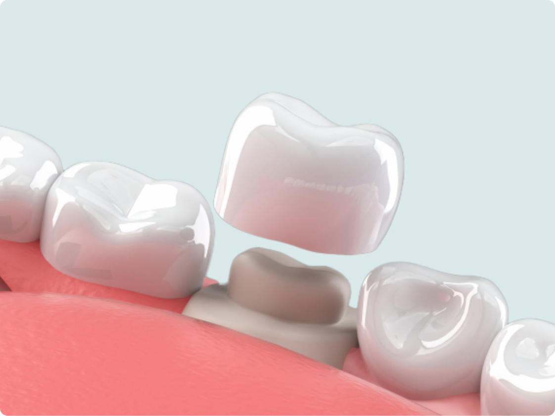 審美セラミック　イメージ