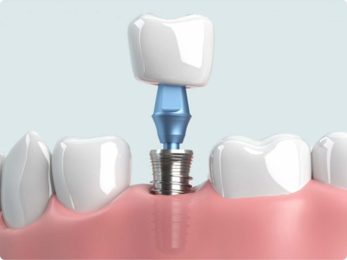 インプラント　イメージ