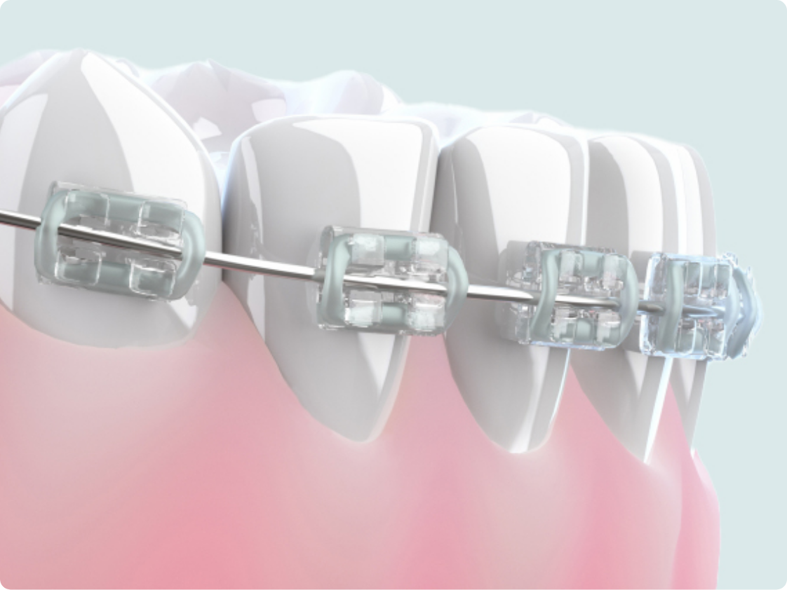 歯列矯正　イメージ