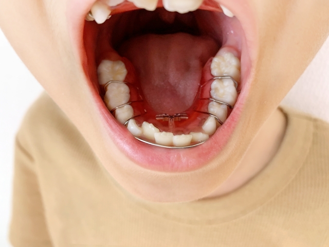 小児期の出っ歯対策:将来のリスクを抑える早期ケア