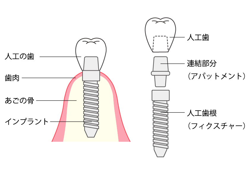 インプラント矯正