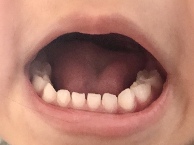 子供のすきっ歯はどう向き合う？乳歯・永久歯それぞれの考え方