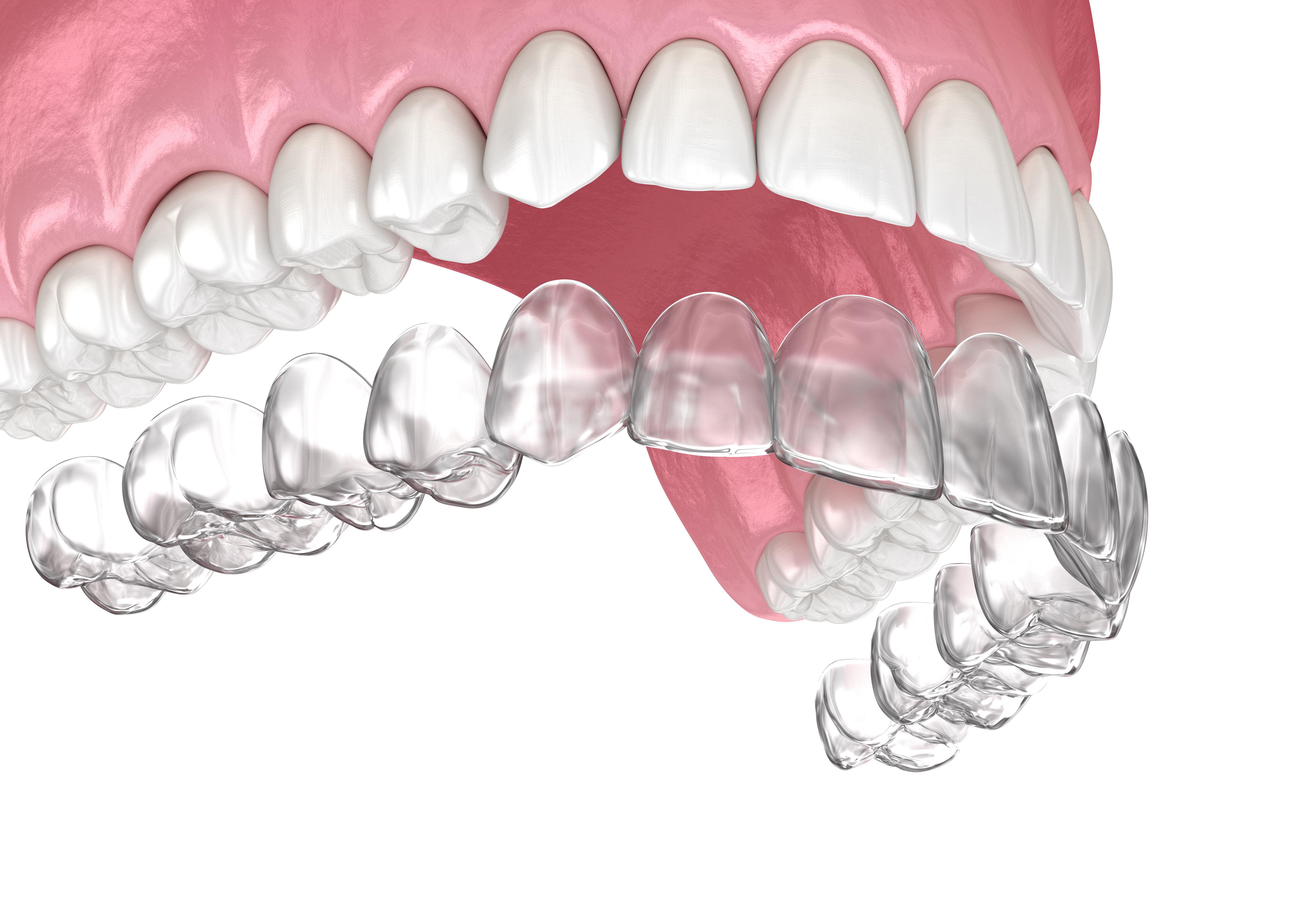 マウスピース矯正（インビザライン等）