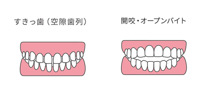 すきっ歯（空隙歯列）と開咬