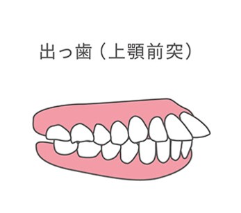 出っ歯（上顎前突）