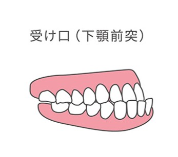 受け口（反対咬合）