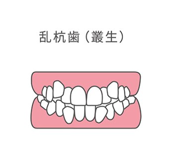 乱杭歯（叢生）