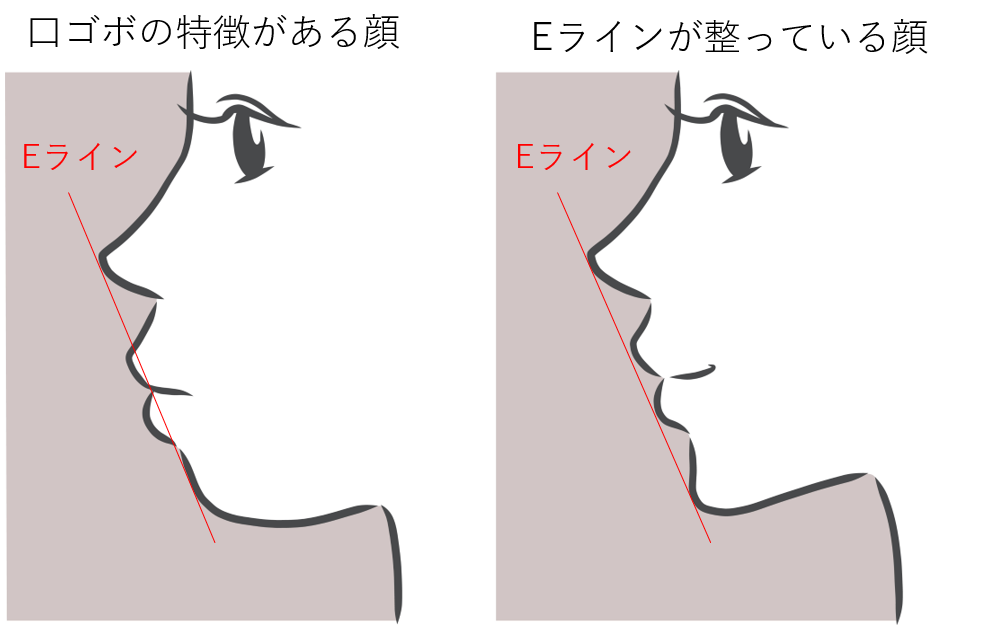 口ゴボのある横顔と、口ゴボのない横顔の比較