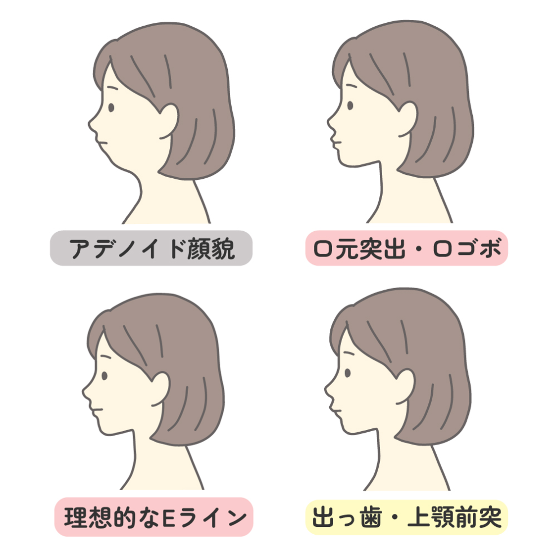 出っ歯と混同されやすい「口ゴボ」や「アデノイド顔貌」との違い