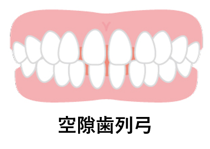 空隙歯列弓（くうげきしれつきゅう）